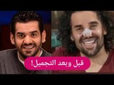 اول تعليق لـ حسين الجسمي بعد خضوعه لـ عملية تجميل الأنف .. ملامحه صادمة !!