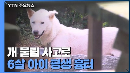 [제보는Y] 개 물림 사고로 6살 아이 평생 흉터..."목줄 풀어놨다" / YTN