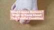 What Causes Bunions? What to Know About This Painful Condition