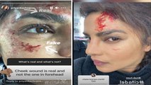 Priyanka Chopra को लगी चोट, Citadel के सेट पर हुई बुरी तरह घायल | FilmiBeat