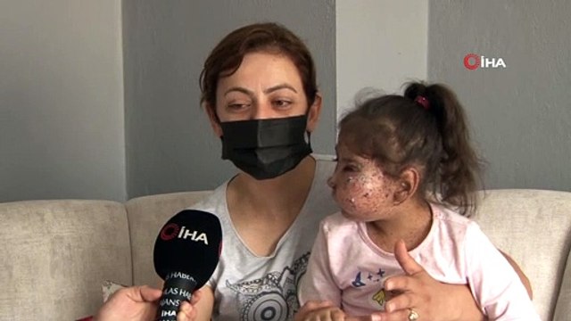 Bir annenin çaresizliği... 9 yaşında 27 ameliyat olan mikrosefali hastası kızı için doktor arıyor