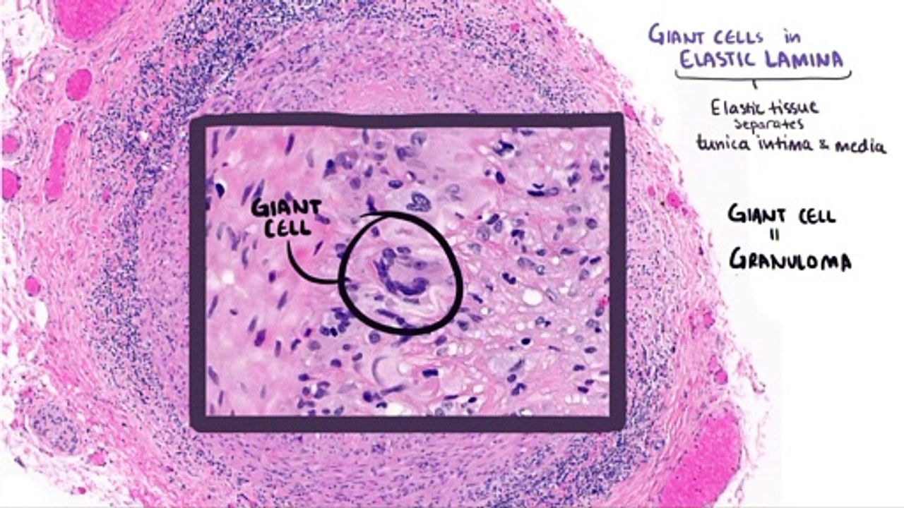 Vasculitis - OSMOSIS