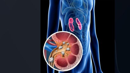 Kidney में Stone होने का खतरा इन लोगों में रहता है ज्यादा ,लक्षणों को न करें नजरअंदाज