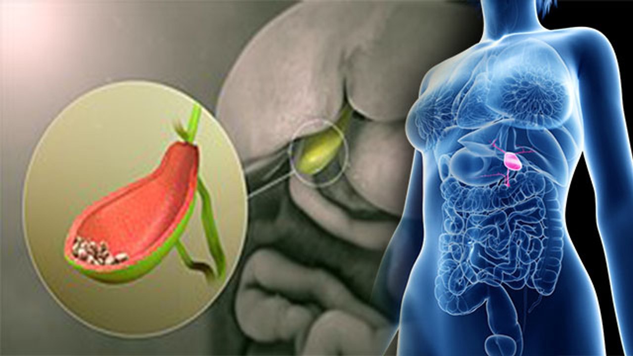 Gall Bladder Stone क्यों होता है, गॉल ब्लैडर पथरी Symptoms चौंकाने वाला | Boldsky