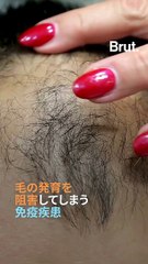 【脱毛症の自分を受け入れたTikToker】