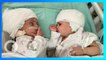 Kepala Bayi Kembar Siam Ini Akhirnya Berhasil Dipisahkan