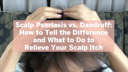 Video herunterladen: Scalp Psoriasis vs. Dandruff: How to Tell the Difference and What to Do to Relieve Your Scalp Itch