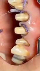 Having teeth we do not know the dignity of the teeth see what condition