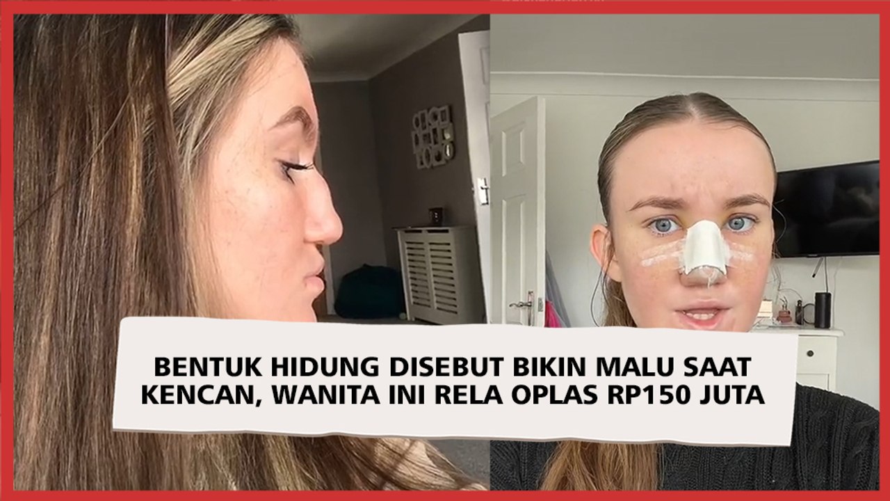 Bentuk Hidung Disebut Bikin Malu saat Kencan, Wanita Ini Rela Oplas Rp150 Juta