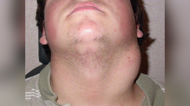 गले में गांठ क्यों होती है ? | Gale Mein Ganth Kyon Hoti Hai | Boldsky