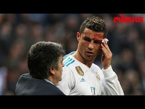 Lokmat Sport Update | Madrid चा स्टार खेळाडू Cristiano Ronaldo रक्तबंबाळ झाला पहा हा व्हिडिओ