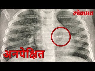 निष्काळजीपणा भोवला सात महिन्यांच्या बाळाने गिळला एलईडी बल्ब | Lokmat Marathi News Update