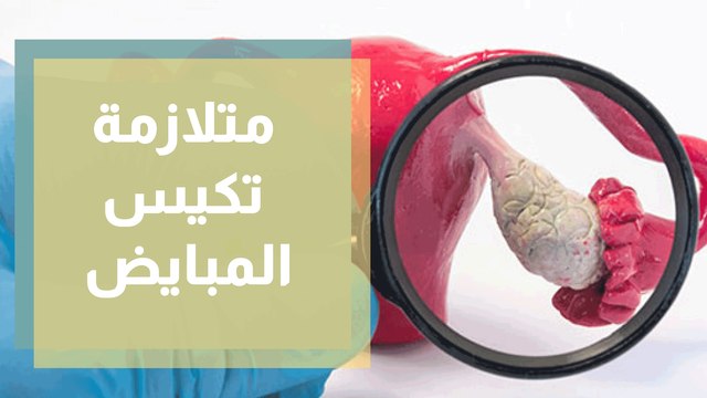 متلازمة تكيس المبايض