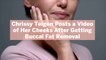 Chrissy Teigen Posts a Video of Her Cheeks After Getting Buccal Fat Removal—Here's What That Is