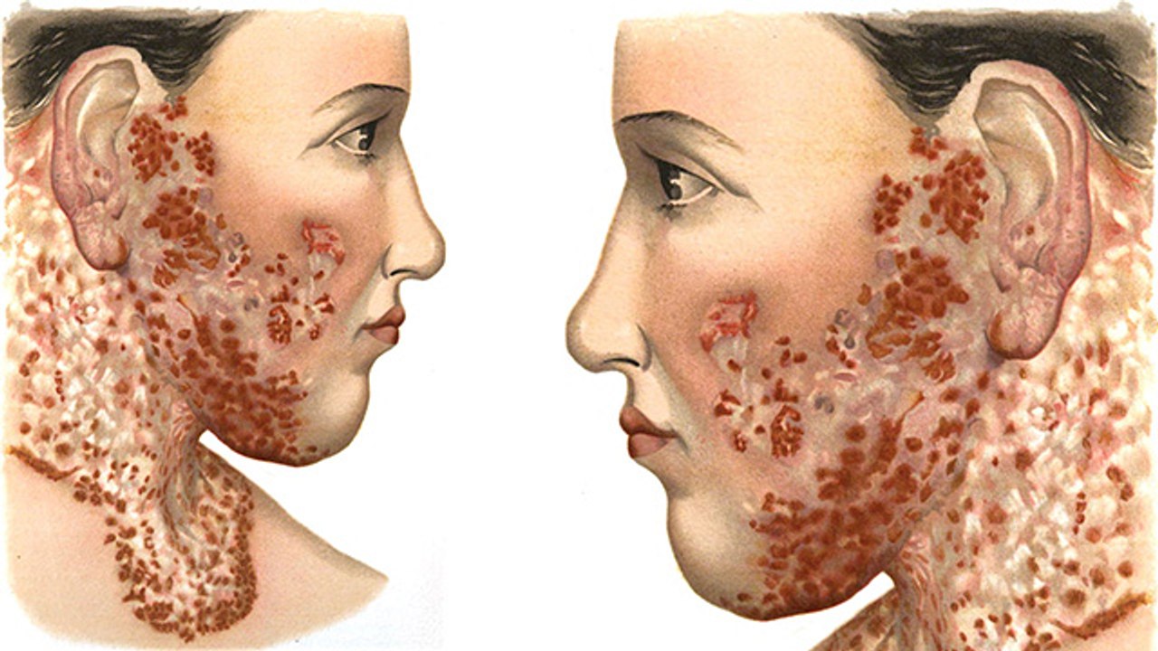 महिलाओं को Lupus बीमारी का ज्यादा खतरा, Symptoms चौंका देंगे | Boldsky