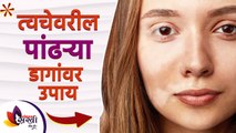 त्वचेवरील पांढरे डाग घालविण्यासाठी घरगुती रामबाण उपाय | How To Get Rid of White Spots On Face |