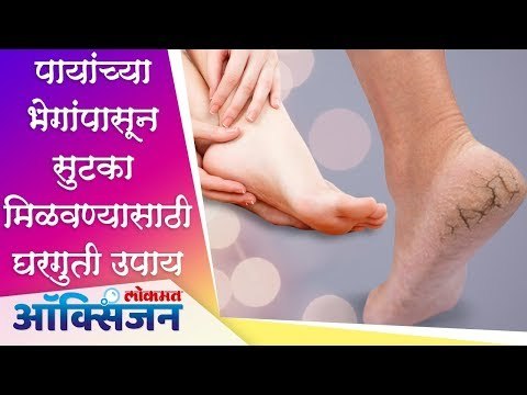 पायांच्या भेगांपासून सुटका मिळवण्यासाठी घरगुती उपाय Remove Cracked Heels Home Remedy | Lokmat Oxygen
