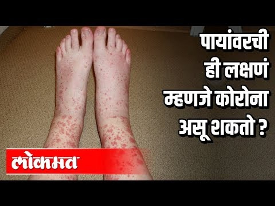 पायांवरची ही लक्षणं म्हणजे कोरोना असू शकतो? Coronavirus Symptoms