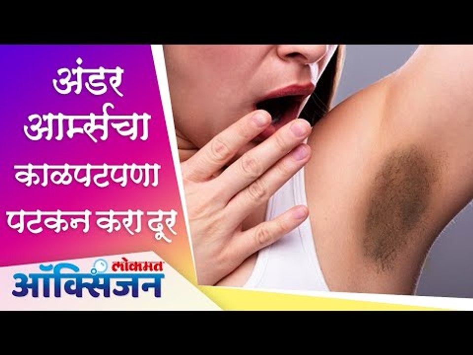 Underarms Whitening At Home | Get Rid Of Dark Underarms | अंडरआर्म्सचा काळपटपणा दूर करा Home Remedy