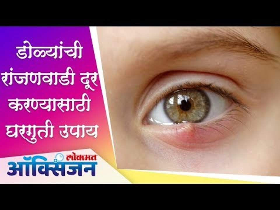 डोळ्यांची रांजणवाडी दूर करण्यासाठी  घरगुती उपाय | Home Remedies | RANJANVADI | Lokmat Oxygen