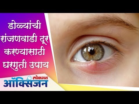 डोळ्यांची रांजणवाडी दूर करण्यासाठी घरगुती उपाय | Home Remedies | RANJANVADI | Lokmat Oxygen