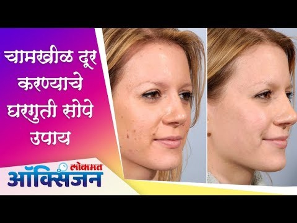 चामखीळ दूर करण्यासाठी सोपे  घरगुती उपाय | Home Remedies | Lokmat Oxygen