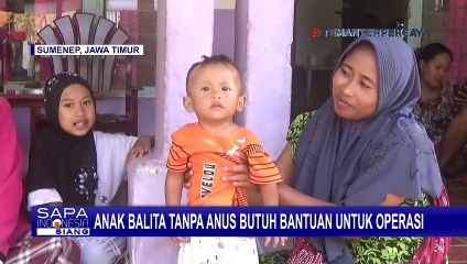 Menderita Kelainan, Seorang Balita di Sumenep Tak Miliki Lubang Anus