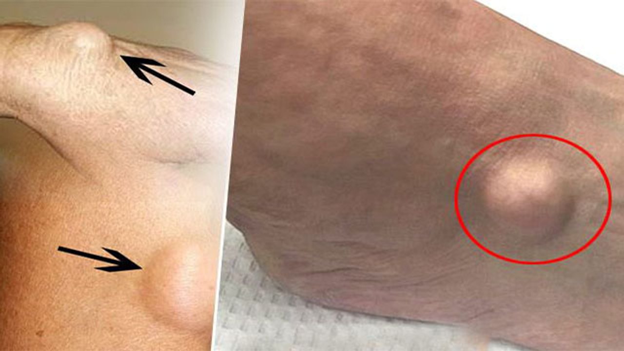 चर्बी की गांठ क्यों होता है ,जानिए इसके Symptoms और घरेलू इलाज के बारे में । Boldsky