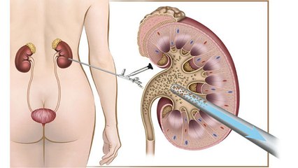 किडनी में पथरी का बिना Surgery हो सकता है इलाज, Doctors Advice | Boldsky