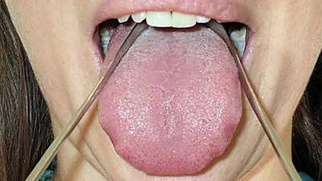 जीभ साफ करना चाहिए या नही । जीभ साफ न करने के नुकसान । Tongue Clean Nahi Karne Ke Nuksan । Boldsky