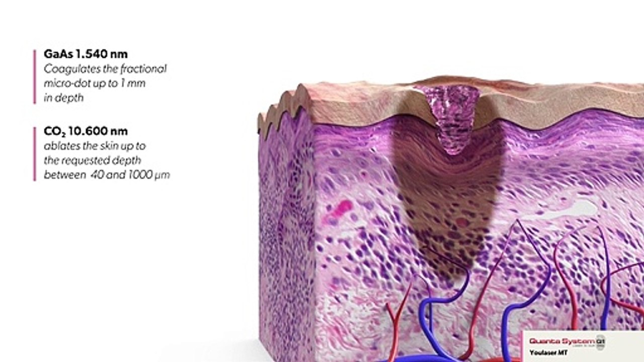 Skin Resurfacing Mixed Technology Overview Bodyvie (1)