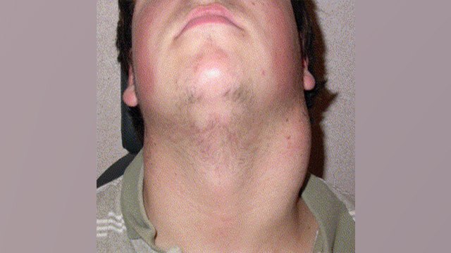 गले में सूजन का कारण | गले में सूजन क्यों होती है | Reason of Sore Throat | Boldsky