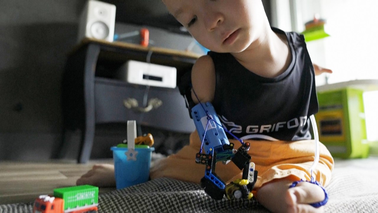 Lego-Prothese hilft Achtjährigem im Alltag