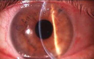 Cajazeiras será a 2ª cidade da Paraíba que sediará encontro para debater retinopatia diabética