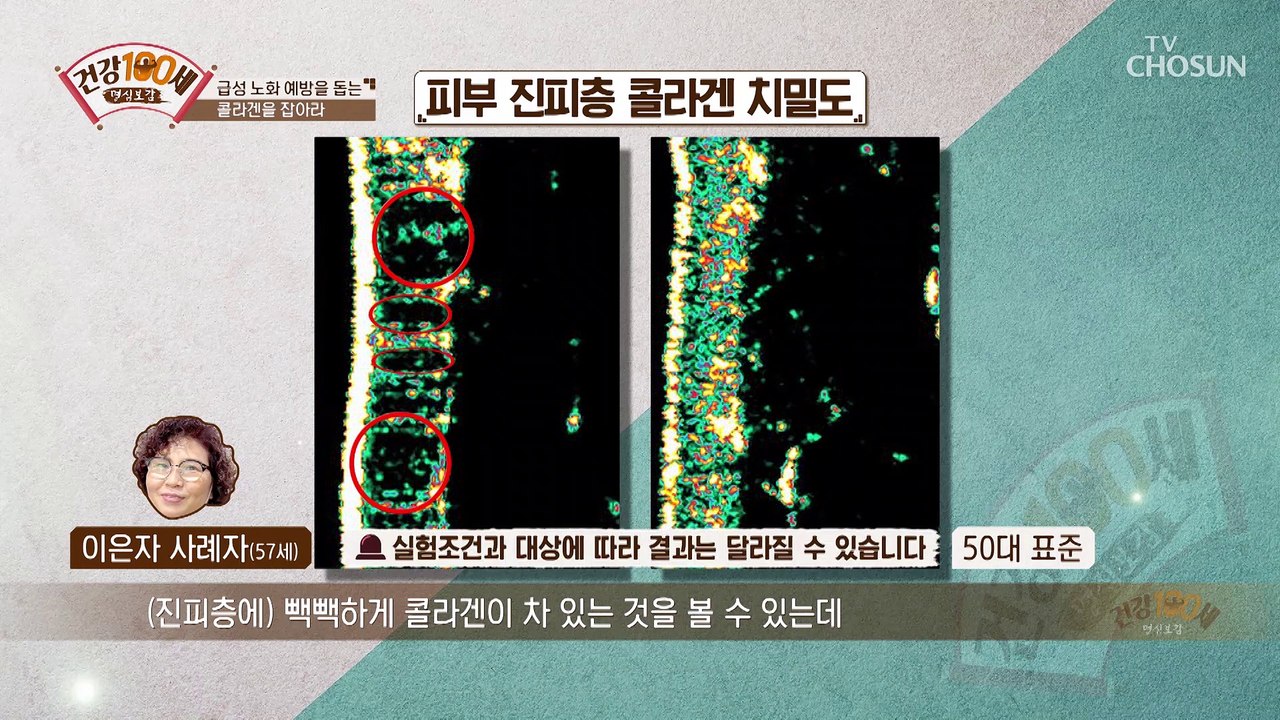 콜라겐 부족➜ 만성 염증 까지? 콜라겐 감소로 인한 질병✓ TV CHOSUN 2109...