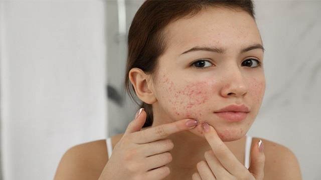 गाल पर हो जाएं Pimples तो भूलकर भी ना करें ये गलती | Boldsky