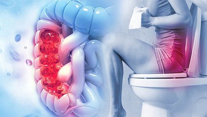 Rectal Cancer क्यों होता है? Rectal Cancer है बेहद खतरनाक जानिए Symptoms और उपाय । Boldsky