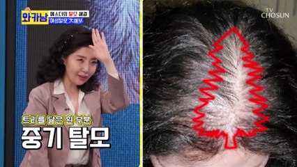 초기엔 내가 알고 말기엔 모두가 아는 여성형 탈모 TV CHOSUN 210928 방송