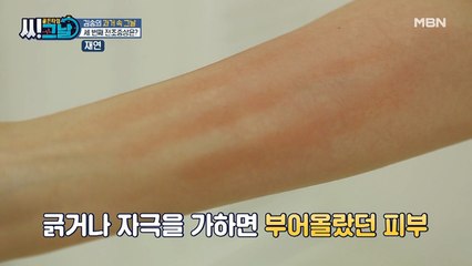 모기야~♪ 피부 묘기(?)증이야! 김송을 괴롭히는 피부 트러블