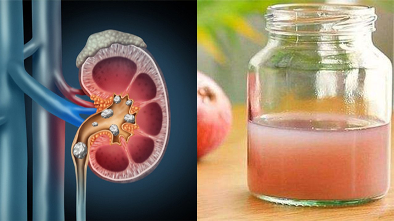 प्याज का रस पीने से क्या होता है, Kidney Stone से लेकर Joint Pain तक से छुटकारा | Boldsky