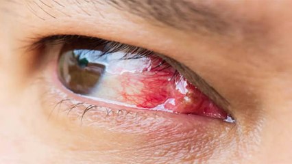 आंखों में मांस क्यों बढ़ता है। आंखों में बढ़े मांस ठीक करने का उपाय । Pterygium Symptoms Treatment