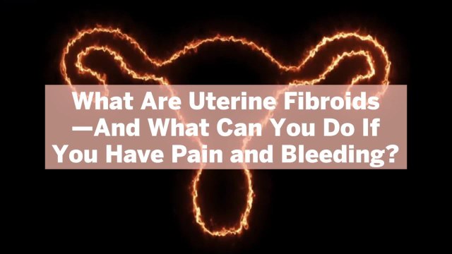What Are Uterine Fibroids—And What Can You Do If You Have Pain and Bleeding?