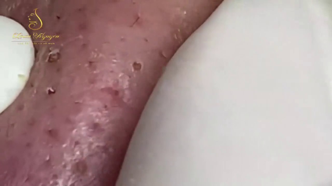 Blackhead Removal #2