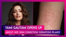 Yami Gautam Opens Up About Her Skin Condition Keratosis Pilaris: What Are Its Causes, Symptoms