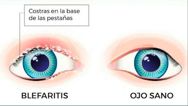 bd-inflamacion-de-parpados-y-tratamientos-051021