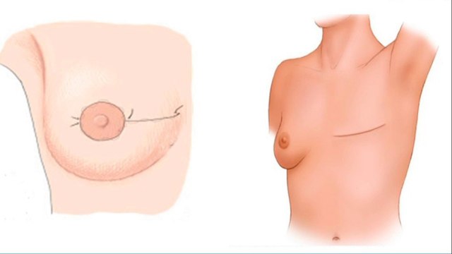 bd-deteccion-tempara-del-cancer-061021