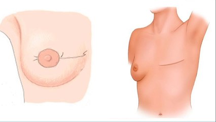 bd-deteccion-tempara-del-cancer-061021