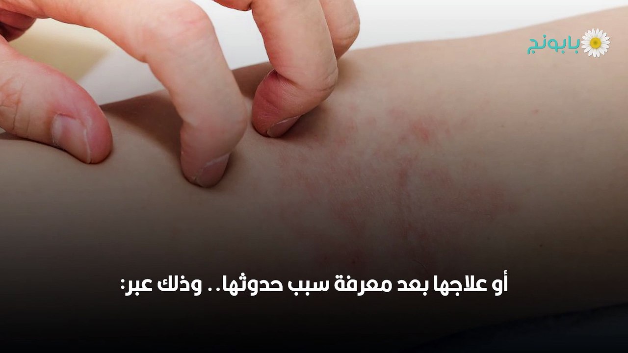 حساسية الشرى وكيفية علاجها نهائيًّا!
