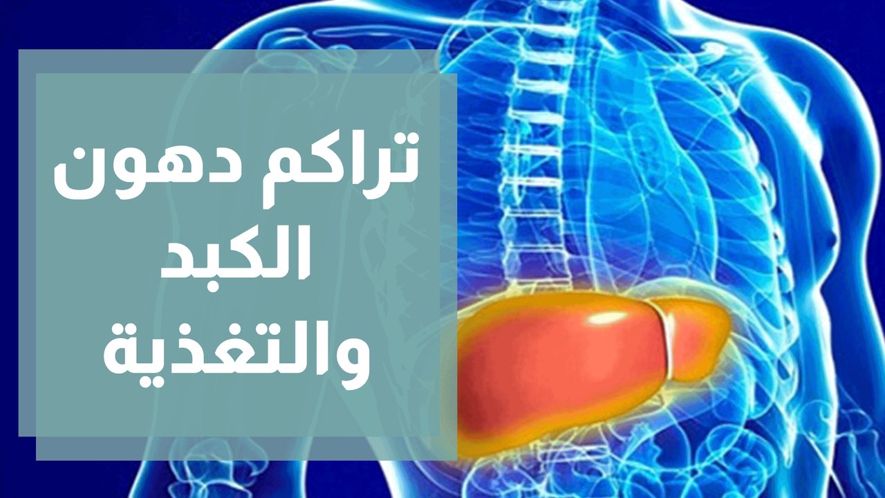 التغذية العلاجية لمشاكل تراكم دهون الكبد