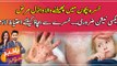 Measles: Symptoms, Diagnosis, and Treatments ... watch video